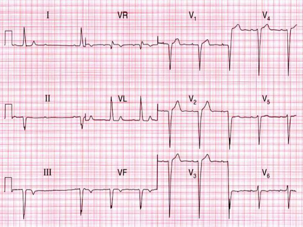 ЭКГ при нарушении проводимости сердца в са азле. Очаговое нарушение проводимости по нижней стенке лж.. Нарушение проводимости сердца фото.