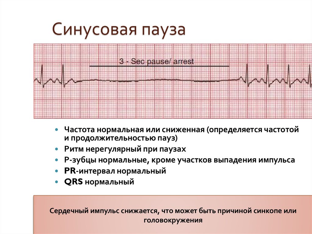 Что значит синусовый ритм сердца на экг. Синусовая пауза на ЭКГ. Синусовая аритмия паузы. Синусовая аритмия на ЭКГ. Пауза ритма на ЭКГ.