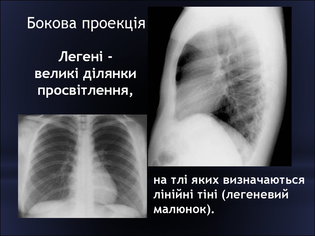 Просветление в легких. Пневмония в боковой проекции. Пневмония снимок боковая проекция. Пневмония рентген боковая проекция. Боковая проекция легких на рентгене.