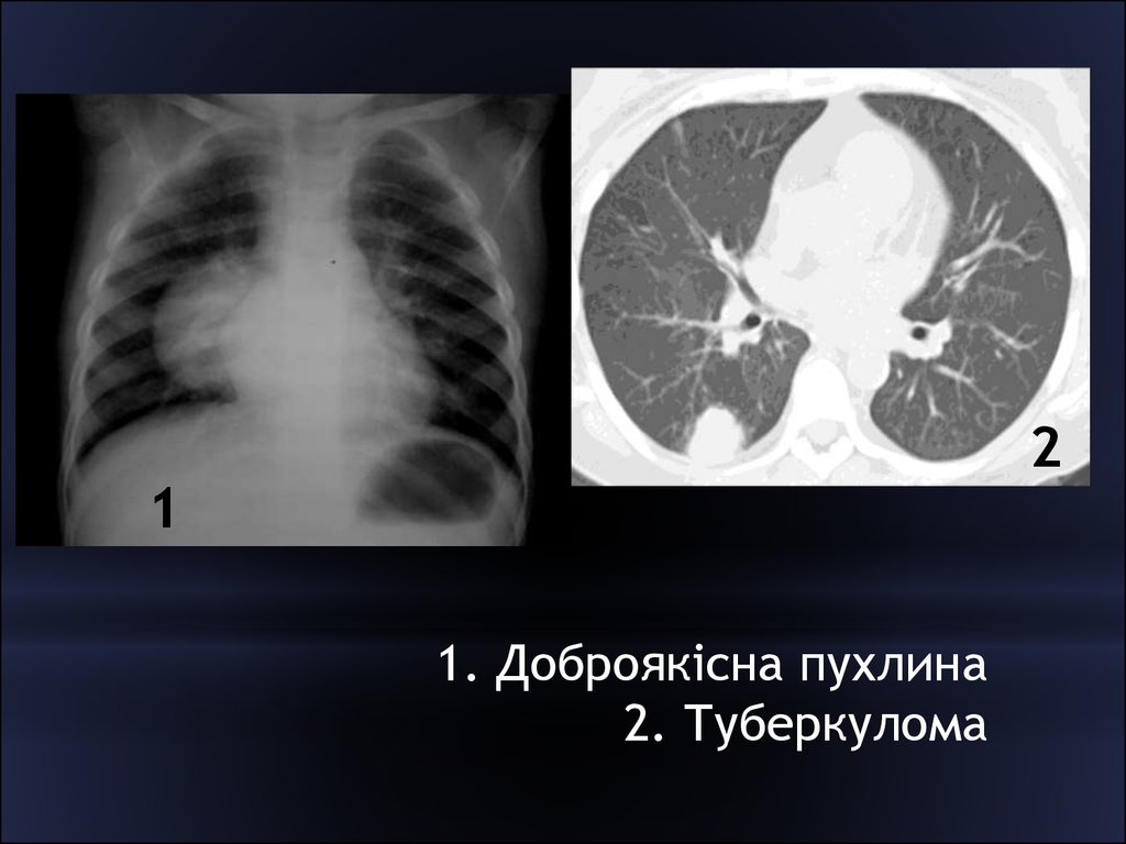 Туберкулома. Туберкулома на кт. Лучевое исследование органов дыхания. Туберкулома лучевые симптомы.