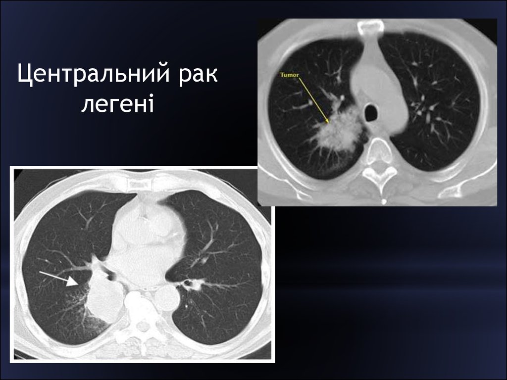 Центральное легкое. Центральная опухоль легкого.