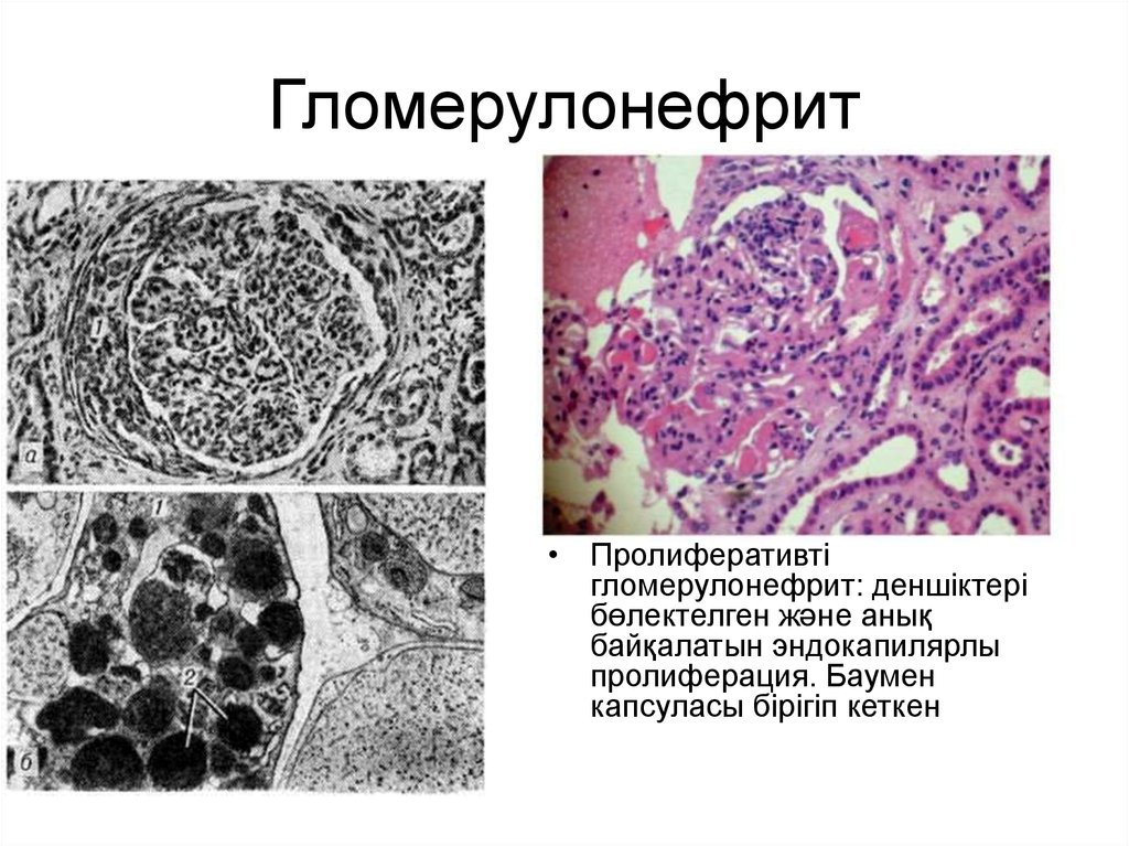 Острый гломерулонефрит картинки