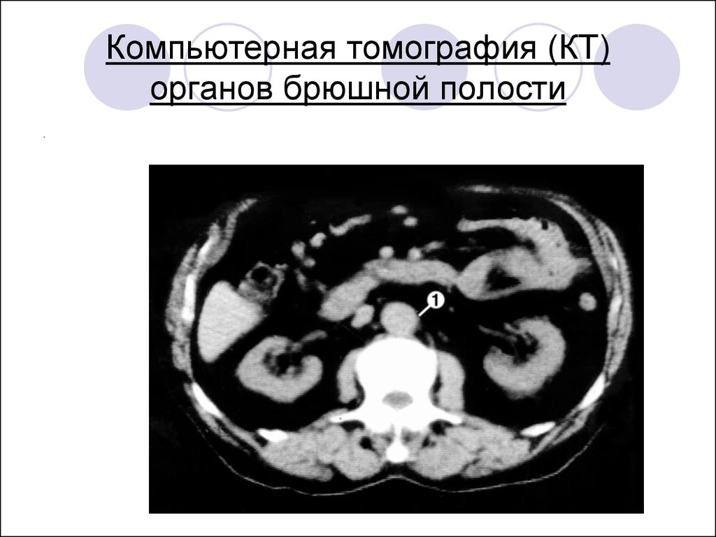 Кт обп. Кт ОБП норма. Кт органов брюшной полости аневризма. Компьютерная томография органов брюшной полости. Кт органов брюшной полости норма.