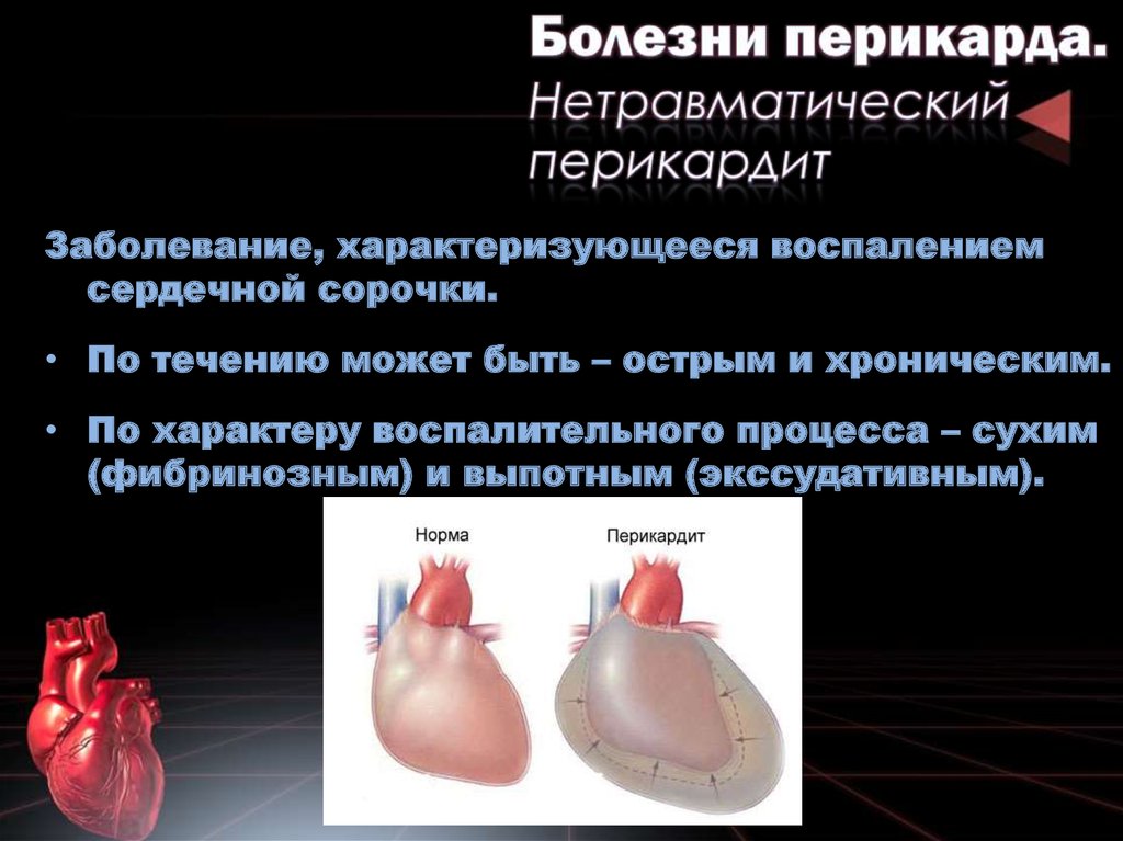 Перикардит симптомы у взрослых. Перикардит (воспаление наружной сердечной оболочки). Нетравматический перикардит – (pericarditis). Строение перикарда.