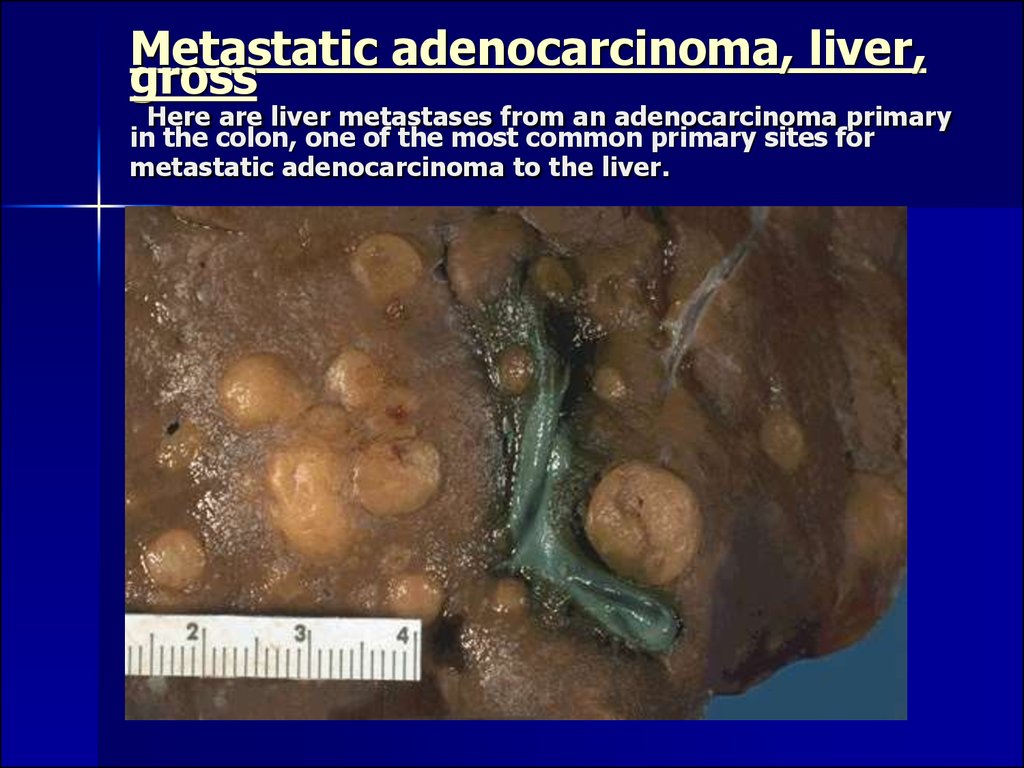 Metastatic adenocarcinoma, liver, gross Here are liver metastases from an adenocarcinoma primary in the colon, one of the most common primary sites for metastatic adenocarcinoma to the liver.