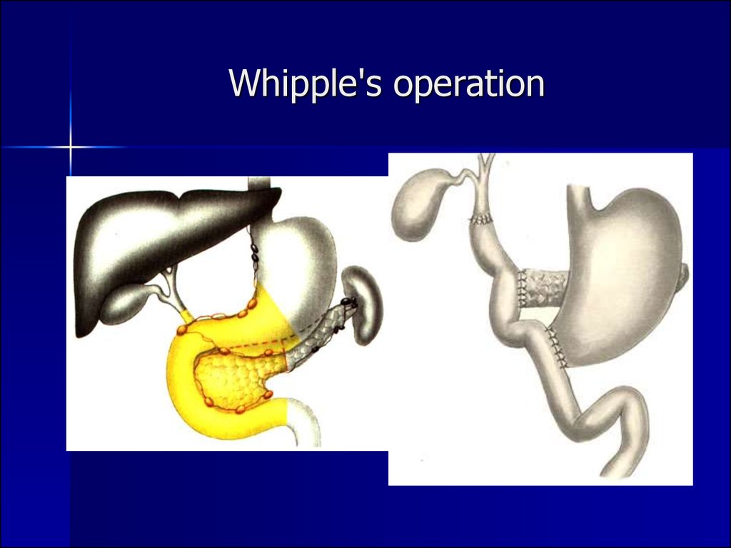 Випла. Панкреатодуоденальная резекция Уиппла. Панкреатодуоденальная резекция операция Whipple. Резекция поджелудочной железы Уиппла.