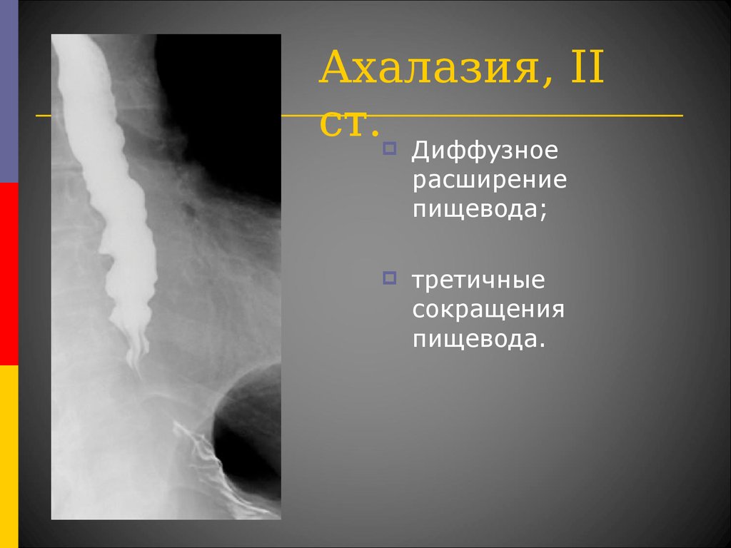 Пищевода 4 стадия. Ахалазия пищевода рентгенодиагностика. Ахалазия пищевода 4 степени. Ахалазия кардии рентген. Степени ахалазии кардии на рентгене.