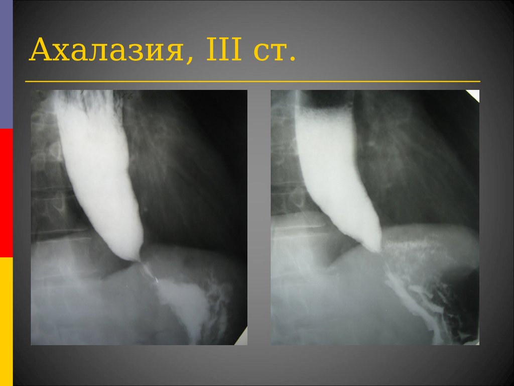 Рентгенологическая картина ахалазии пищевода