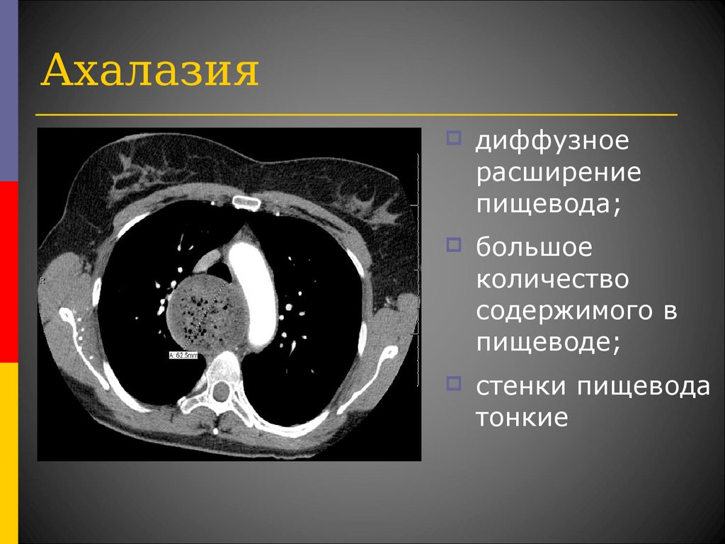 Ахалазия кардии презентация