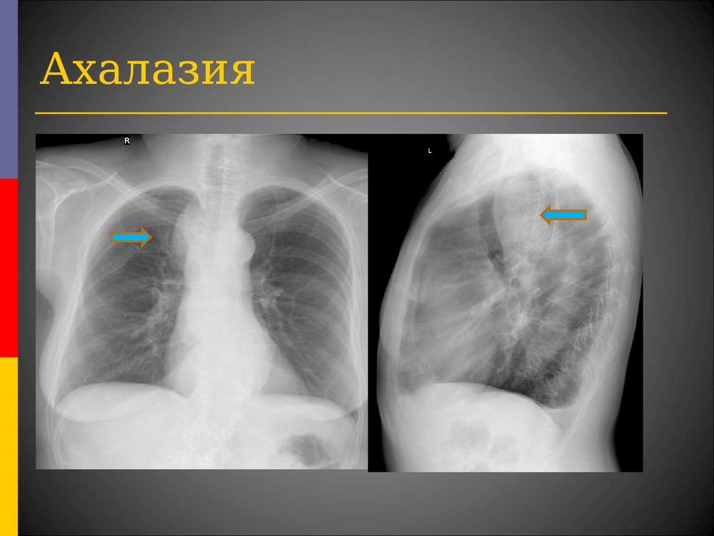 Рентгенологическая картина ахалазии пищевода при контрастировании