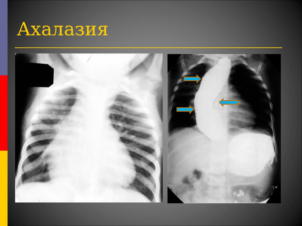 Ахалазия кардии презентация