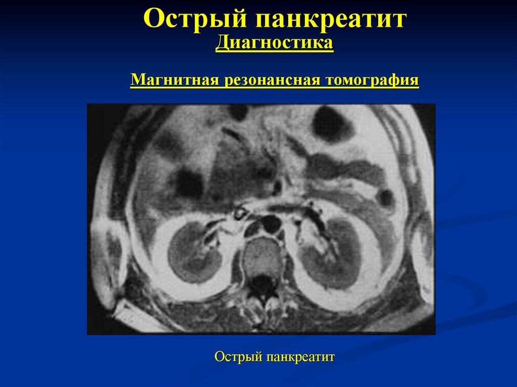 Панкреатит диагностика. Деструктивный панкреатит мрт. Хронический панкреатит мрт.
