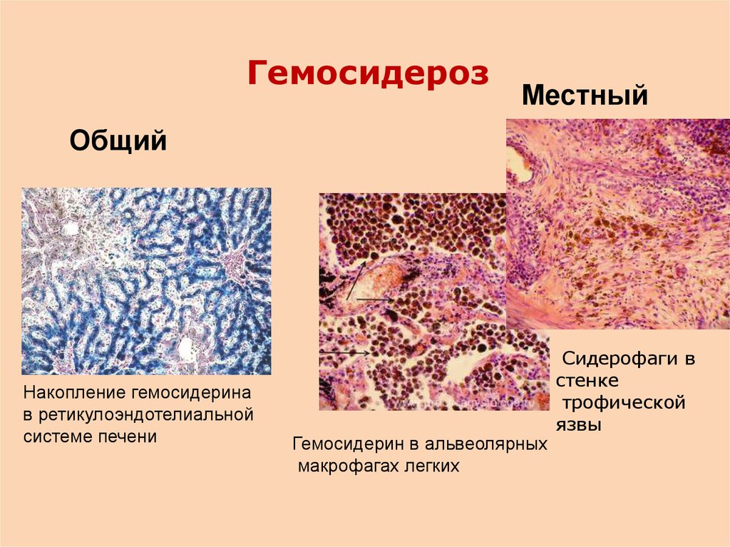 Железо в макрофагах. Гемосидероз легкого патологическая анатомия. Гемосидероз печени проявляется. Гемосидероз селезенки препарат. Гемосидероз легкого патанатомия.