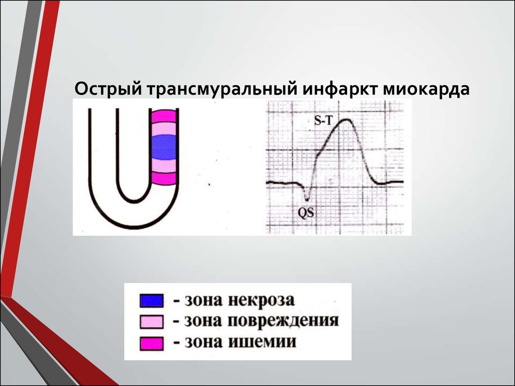 Трансмуральный инфаркт. Трансмуральный инфаркт миокарда. Острый трансмуральный инфаркт. Острый трансмуральный Нижний инфаркт миокарда. Трансмуральное повреждение миокарда.