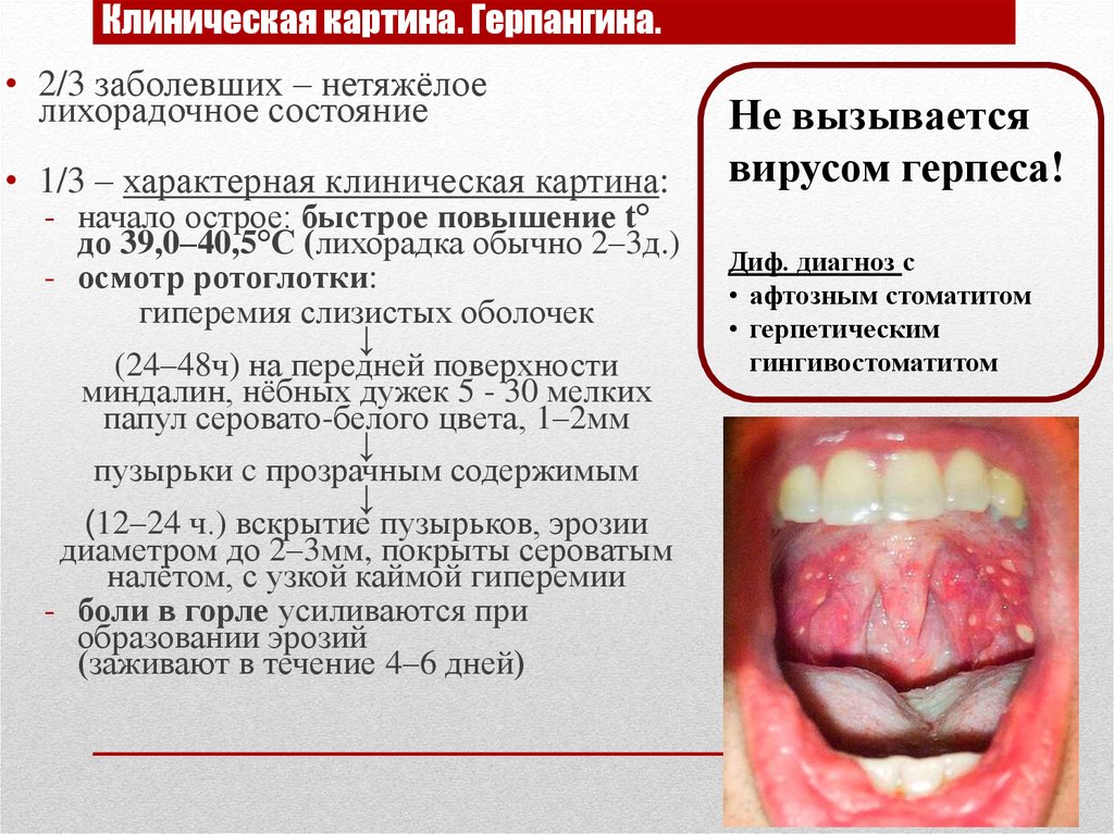 Энтеровирусный везикулярный стоматит фото