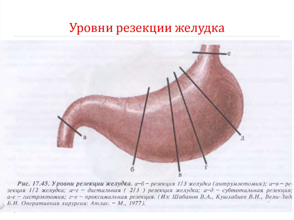 Почему после удаления желудка