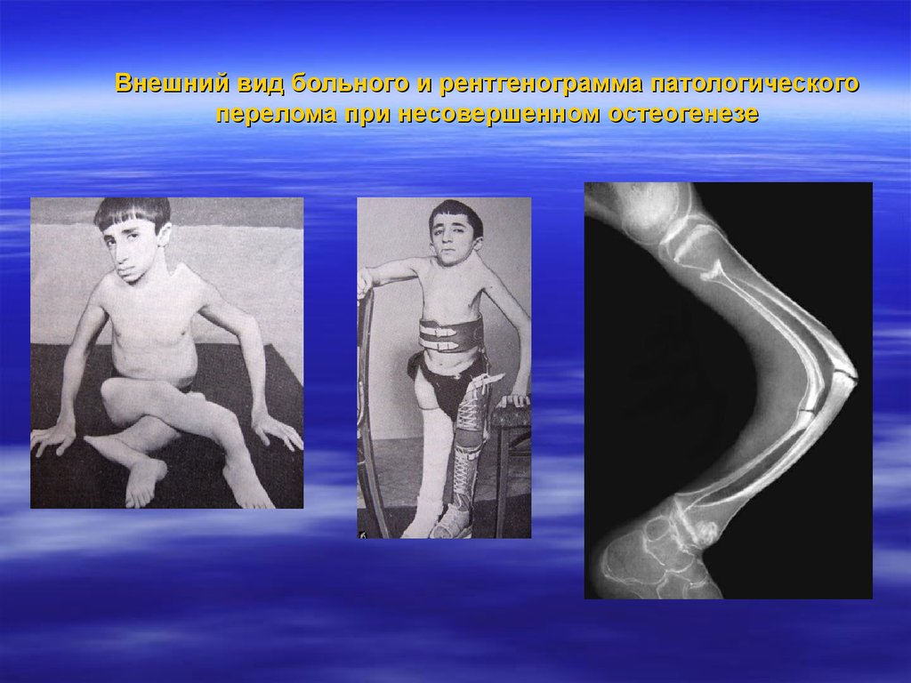 Внешний вид больного и рентгенограмма патологического перелома при несовершенном остеогенезе