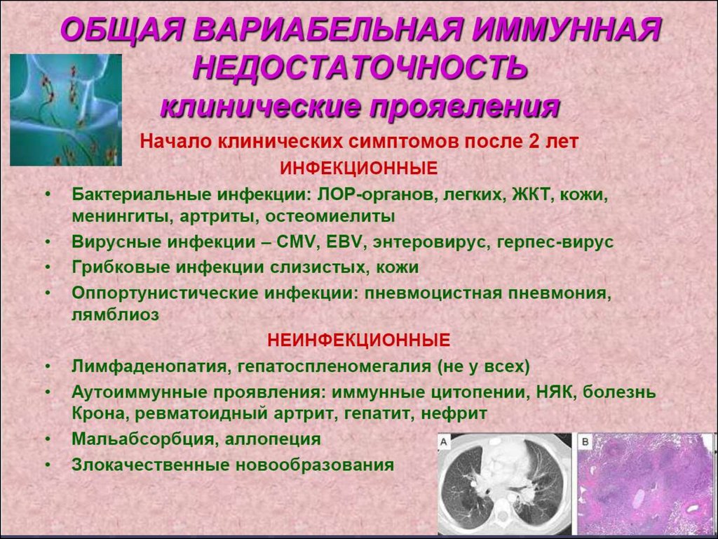 Иммунодефициты у детей презентация