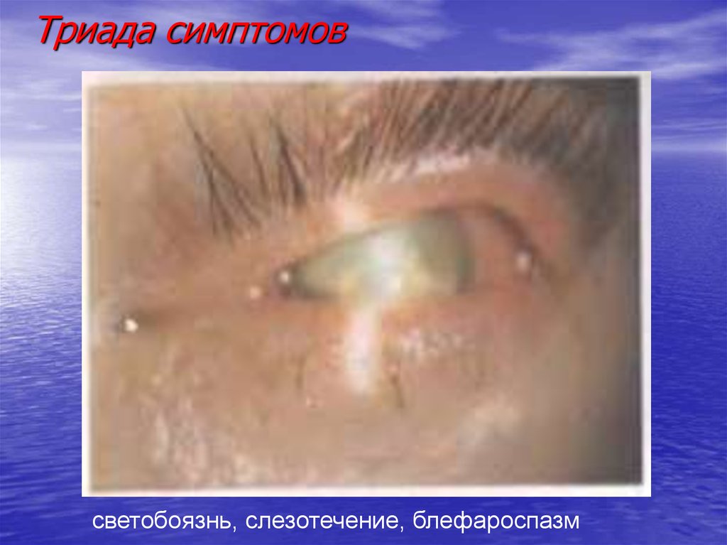 Триада симптомов