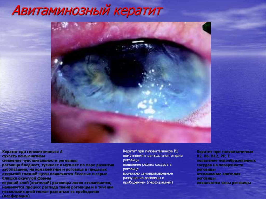 Авитаминозный кератит