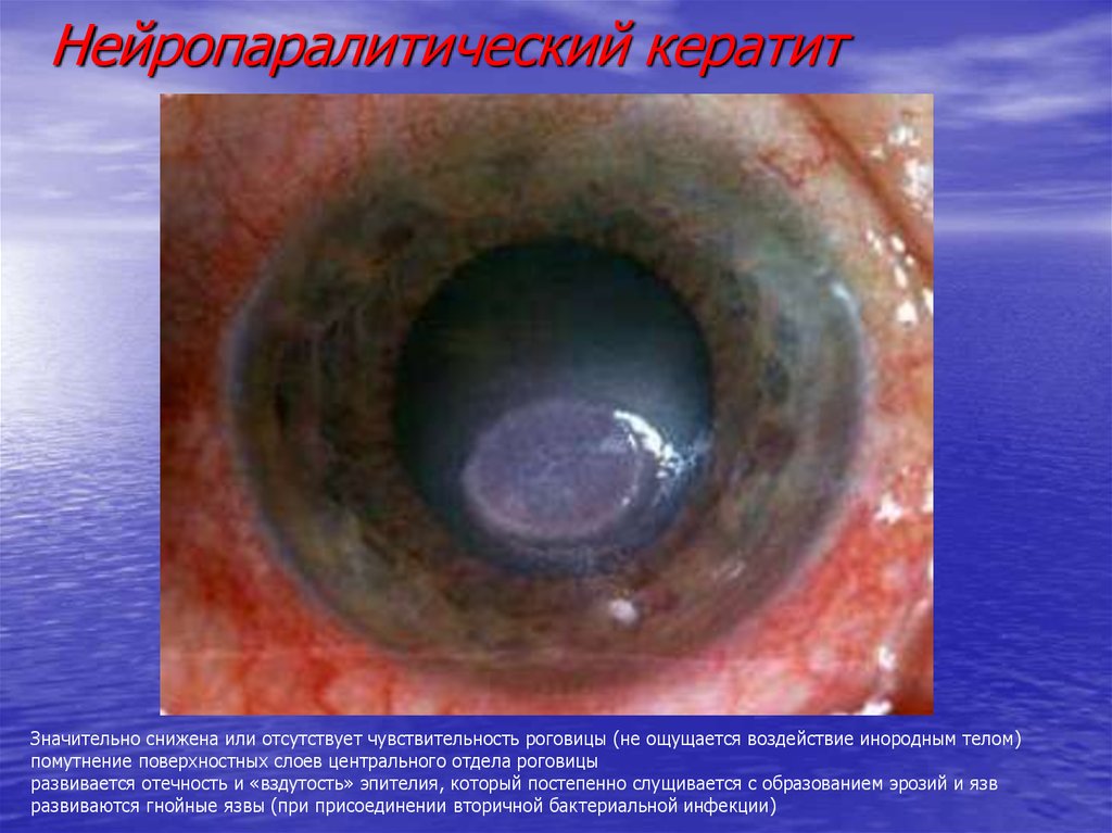 Нейропаралитический кератит