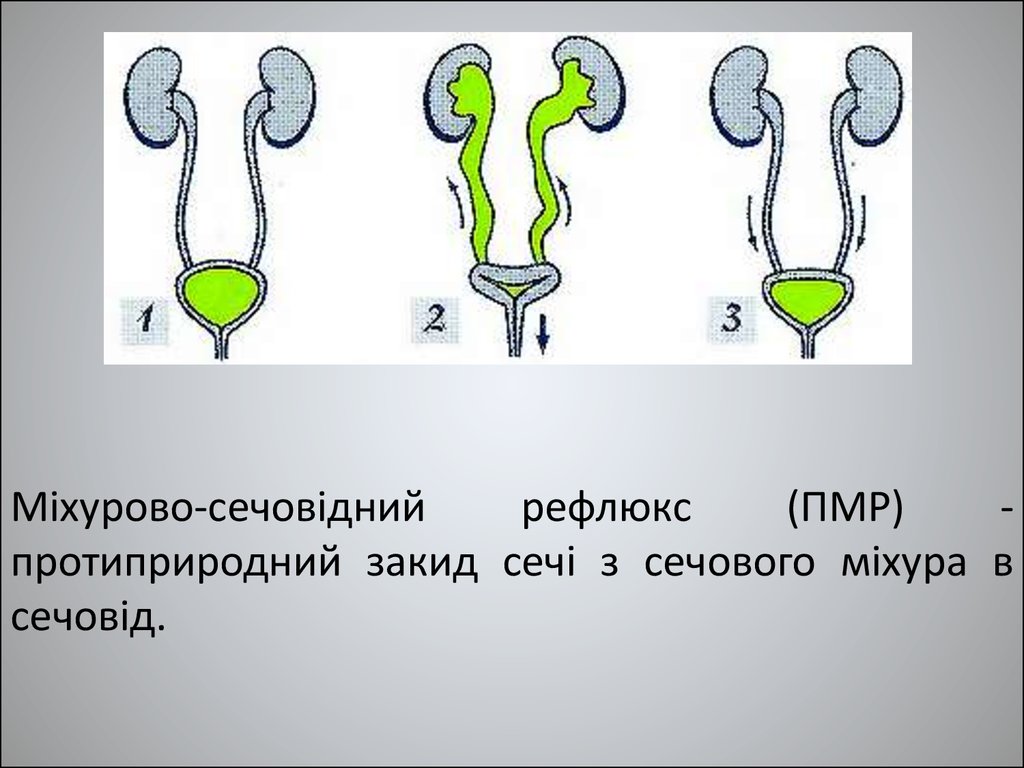 Изгибы мочеточника