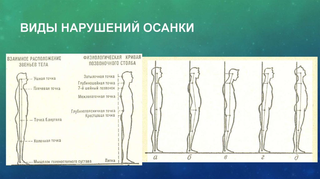 Виды осанки