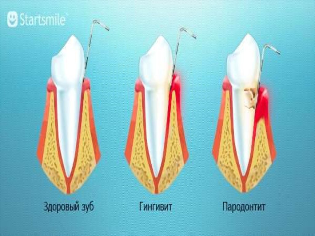 Пародонтит зуба