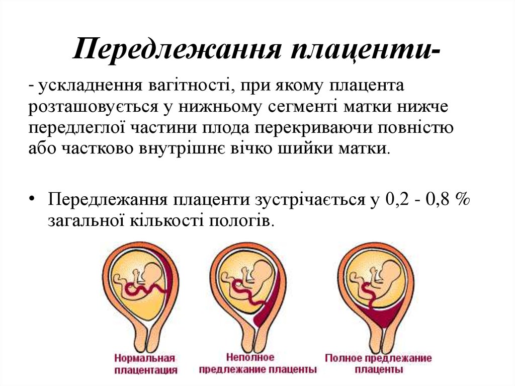 Что значит низкая плацентация при беременности