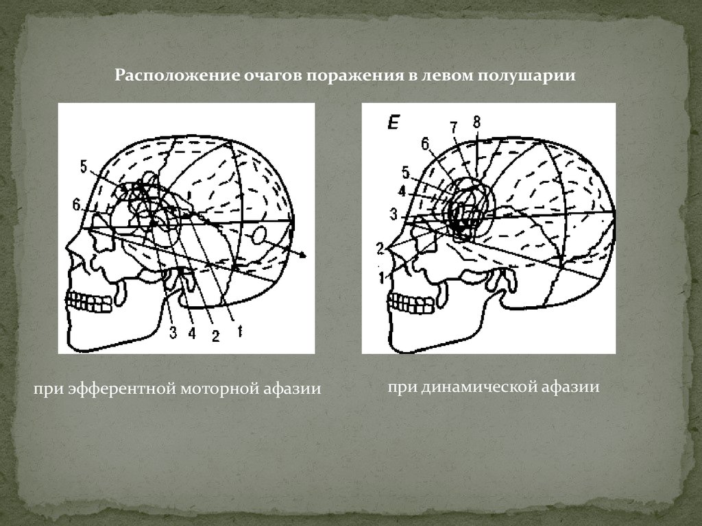 Динамическая афазия. Афазия очаг поражения. Динамическая афазия очаг поражения. Очаги поражения при афазии. Очаг поражения при динамической афазии.