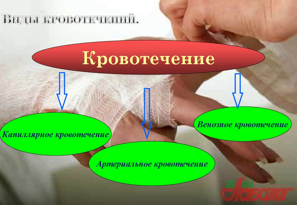 Виды кровотечений.