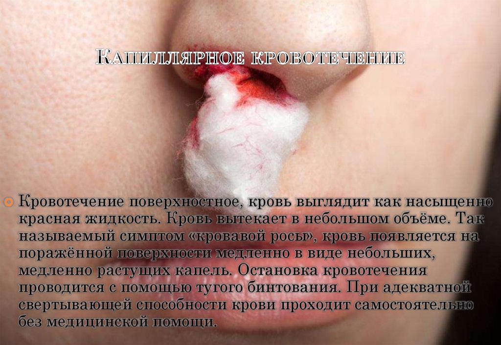 Капиллярное кровотечение