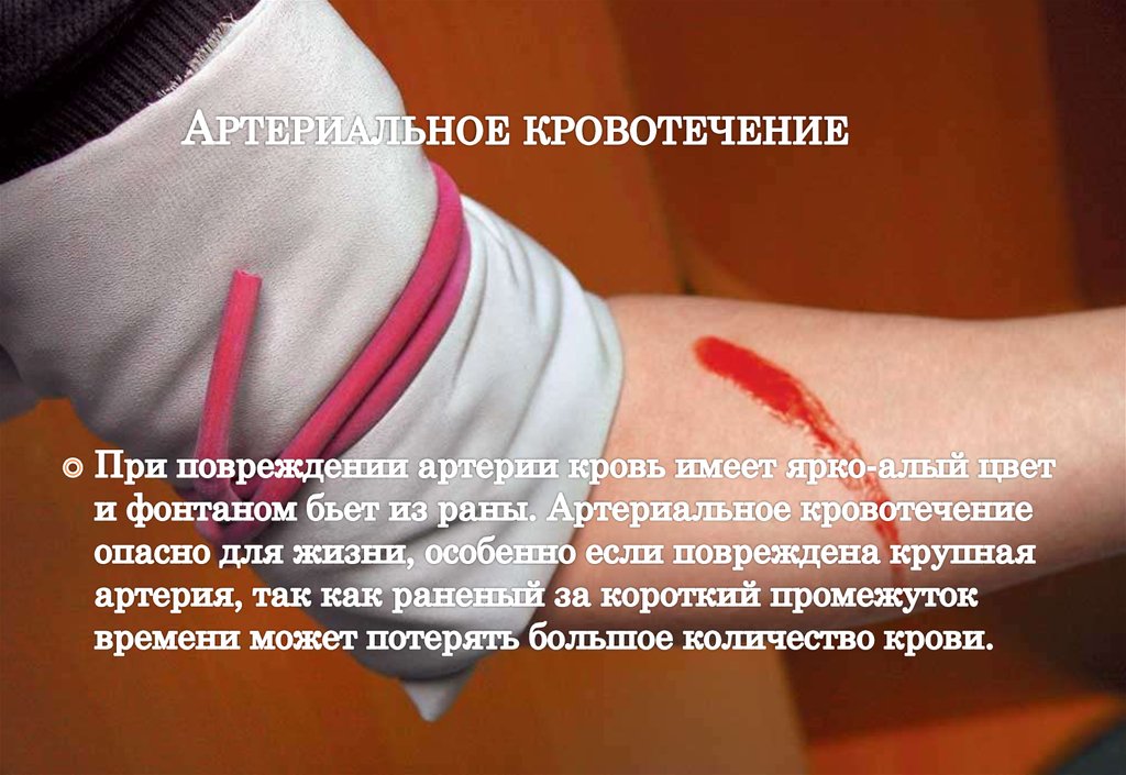 Артериальное кровотечение