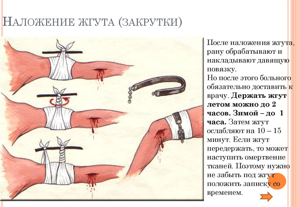 Наложение жгута (закрутки)