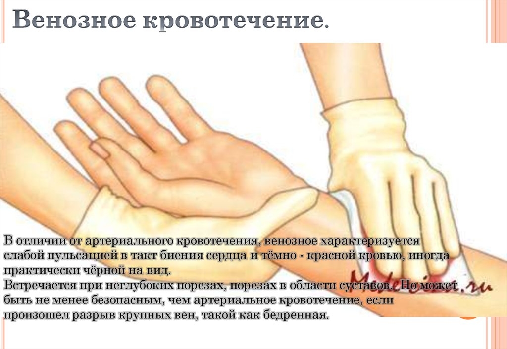 Венозное кровотечение.