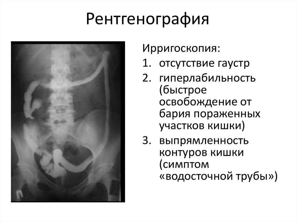 Кал при язвенном колите фото