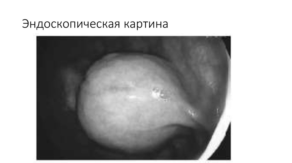 Эндоскопическая картина гпод