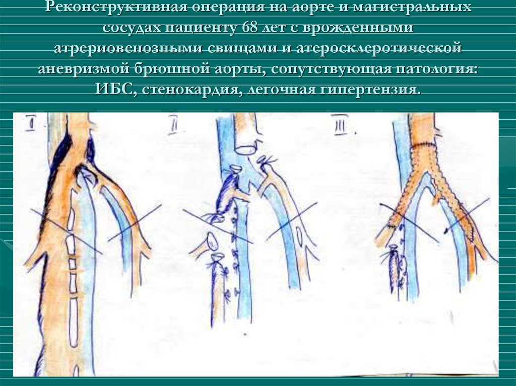 Операция на сосуды. Операции на магистральных сосудах Оперативная хирургия. Реконструктивные операции на аорте. Реконструктивная сосудистая операция.