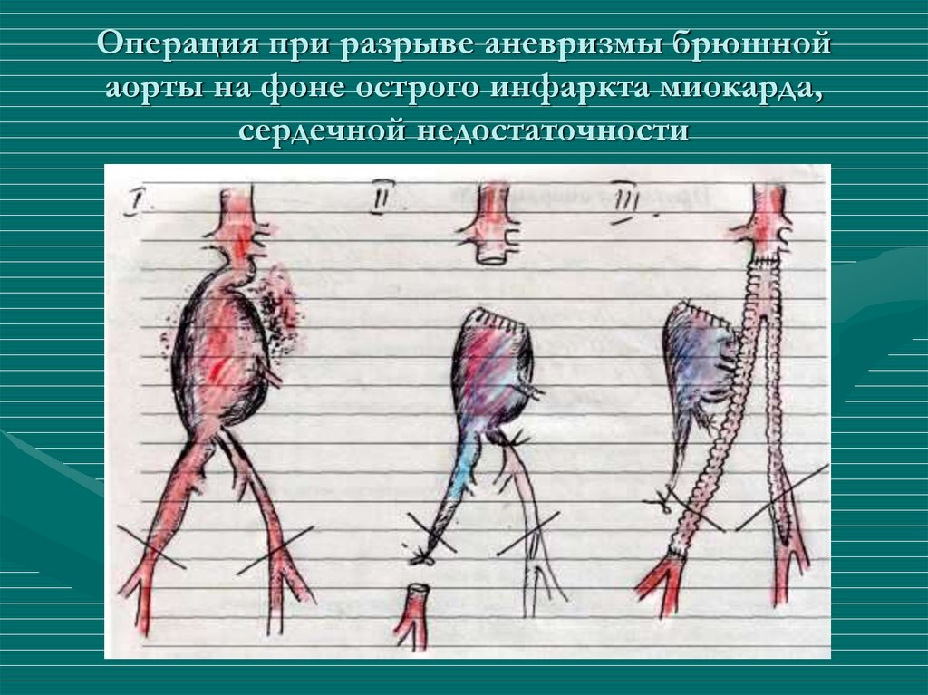 От чего бывает разрыв аорты. Операции при аневризме аорты. Операции при аневризме брюшной аорты. Операции при разрыве аневризмы. Аневризма брюшной аорты разрыв.