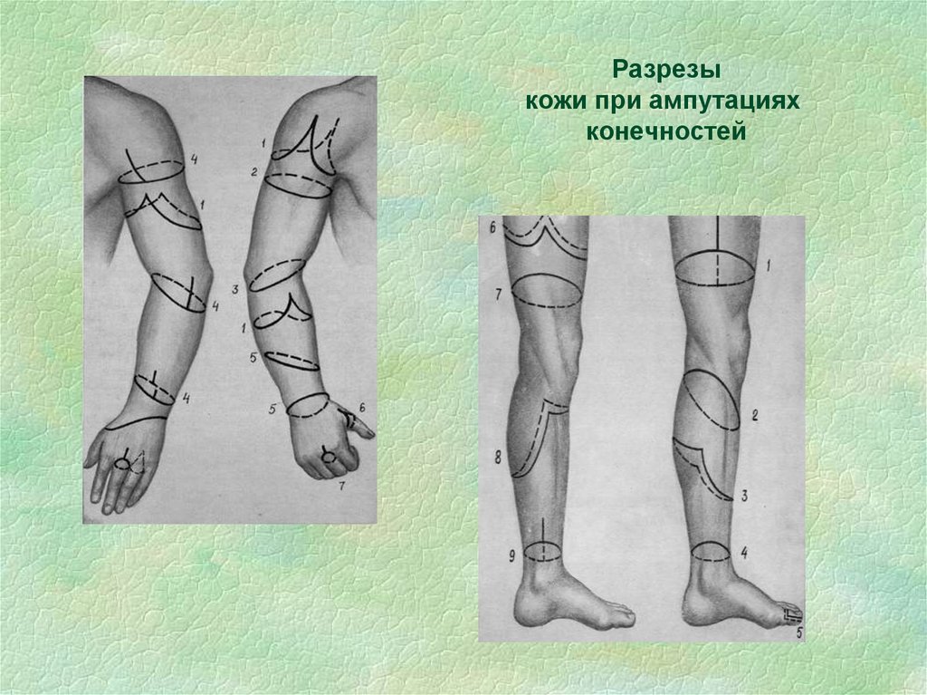 Уровне нижней трети голеней. Ампутация конечности Оперативная хирургия. Ампутация нижней конечности. Ампутация нижней конечности схема.