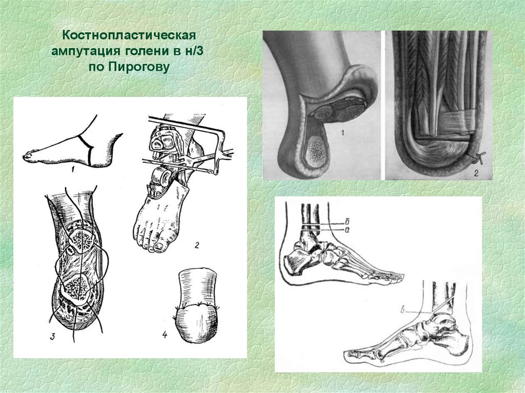 Пирогов костно пластическая ампутация голени