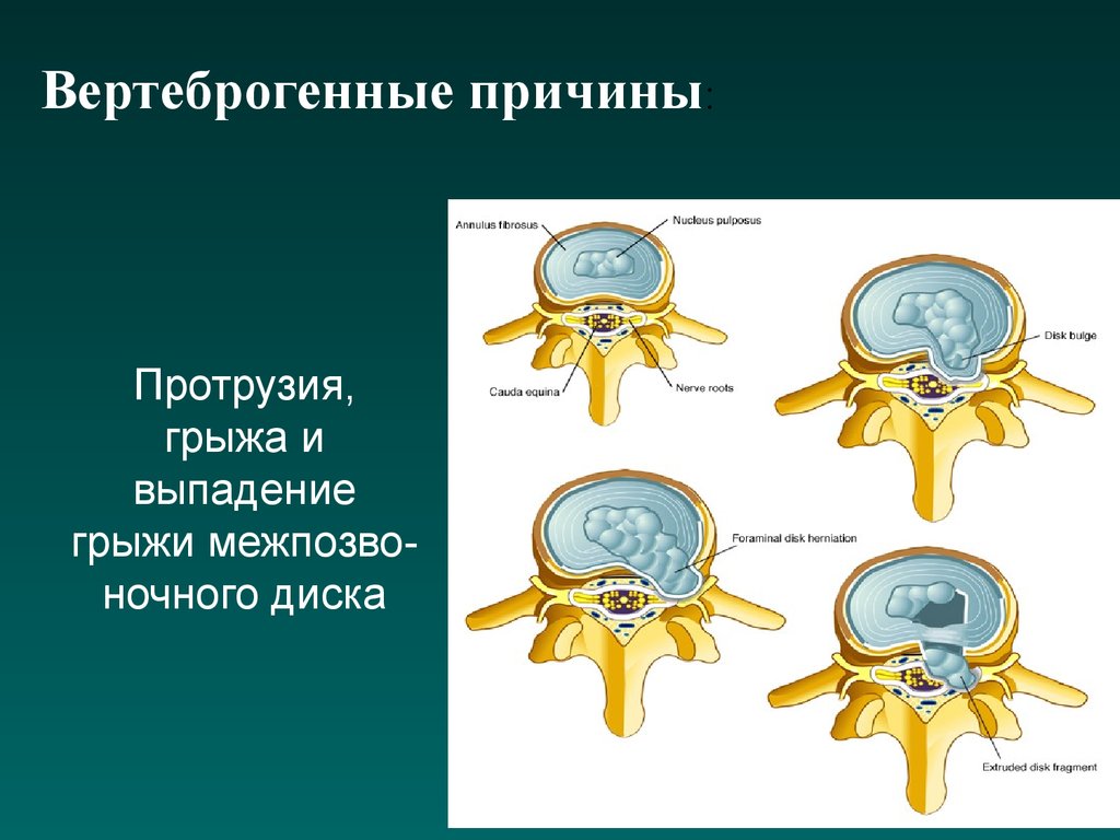 Вертеброгенный синдром люмбоишиалгии