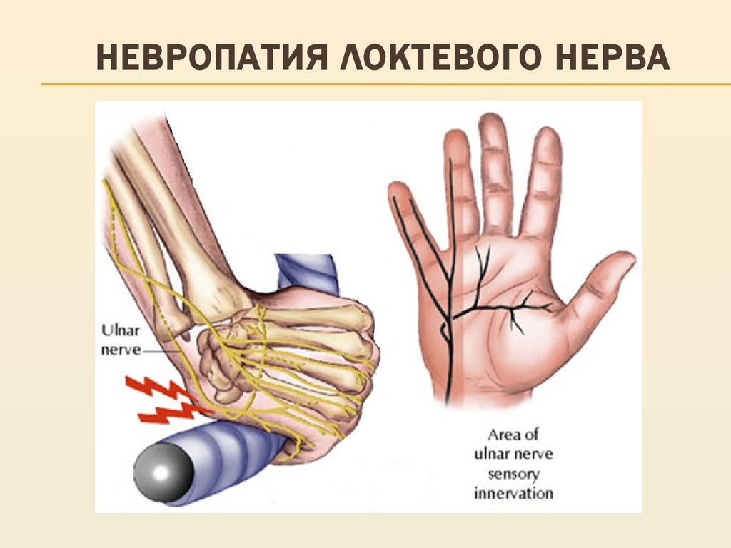 Нейропатия локтевого нерва фото