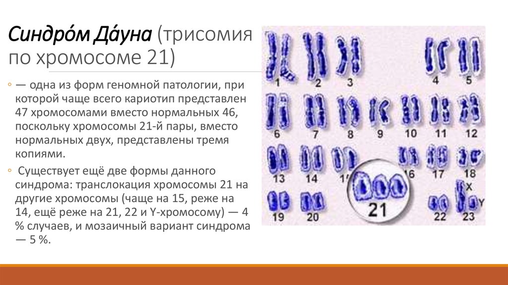 Кариотип синдрома дауна. Синдром Дауна 21 хромосома. Болезнь Дауна набор хромосом. Трисомия по 21 хромосоме кариотип. Синдром Дауна трисомия по 21 хромосоме.