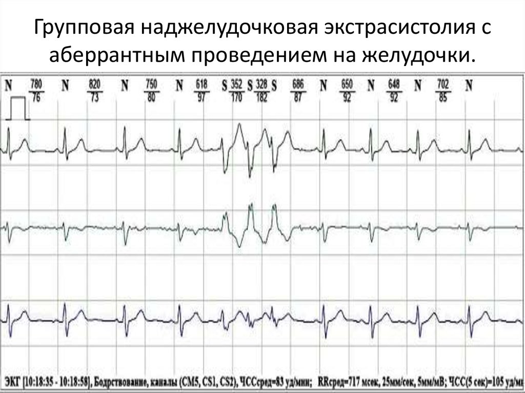 Жэс в кардиологии