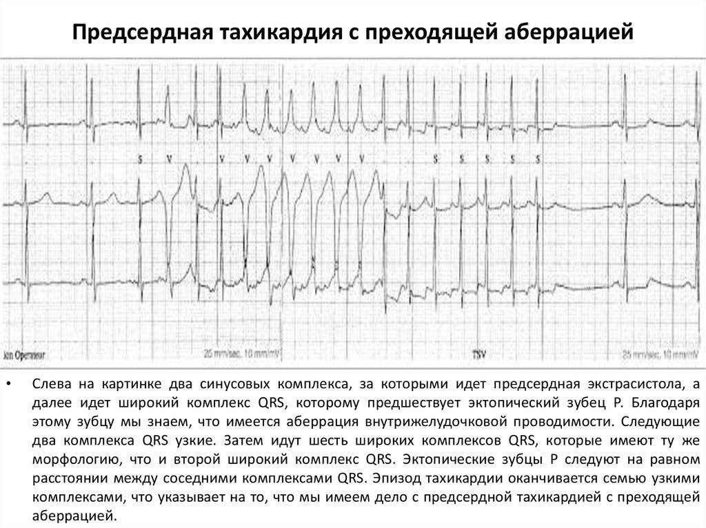 Аберрантные экстрасистолы. Пароксизмальная экстрасистолия ЭКГ. Предсердная экстрасистолия с аберрантным комплексом. Пароксизмальная тахикардия предсердий ЭКГ. Наджелудочковая экстрасистолия на ЭКГ.