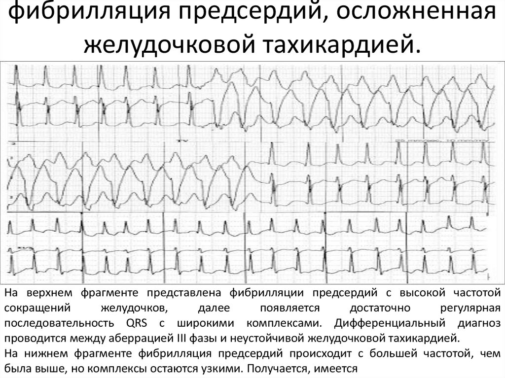 Желудочковая экстрасистолия карта вызова смп