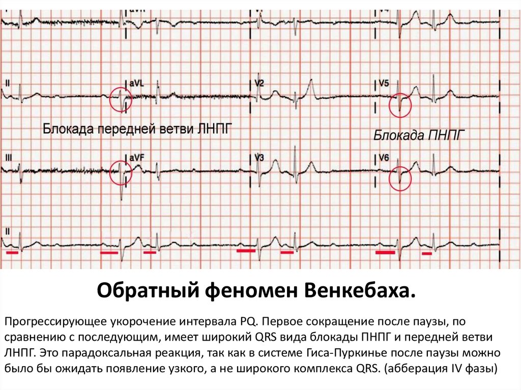 Феномен укороченного pq