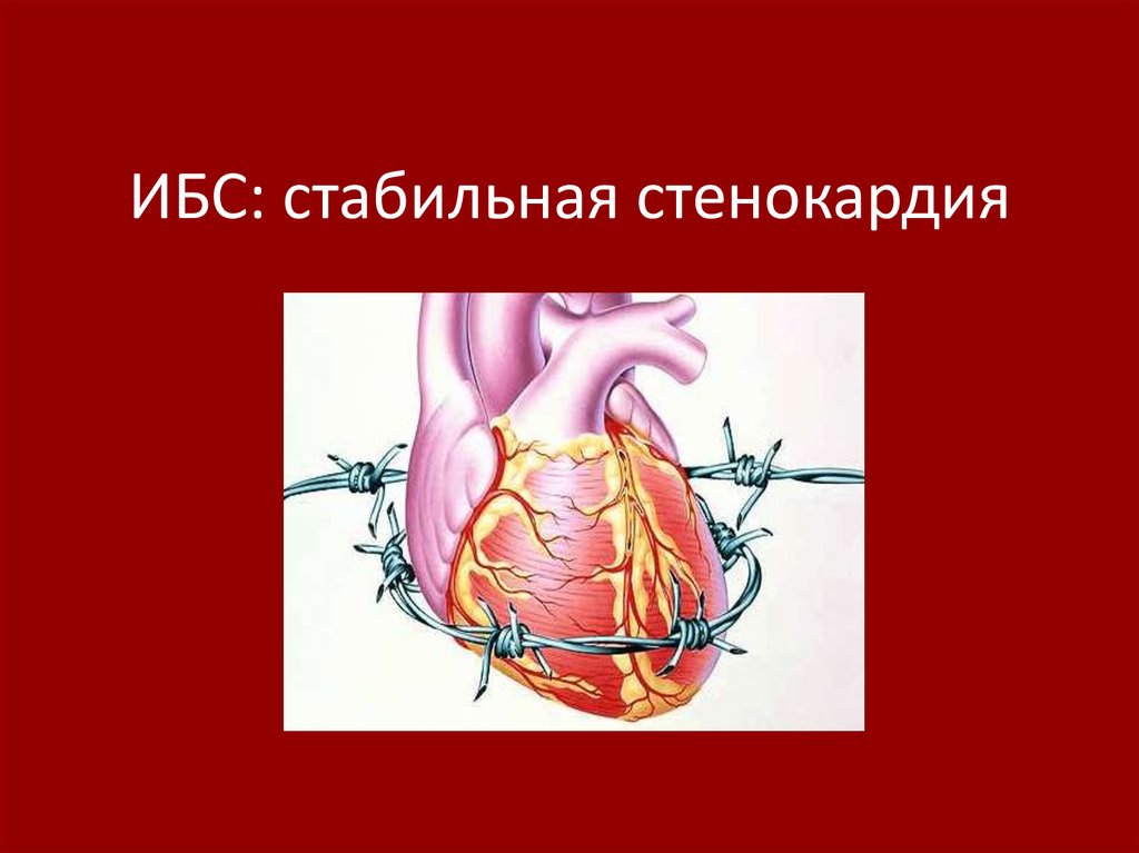 Ишемия передней стенки. ИБС стабильная стенокардия. ИБС стенокардия презентация. Ишемическая кардиомиопатия стабильная стенокардия.