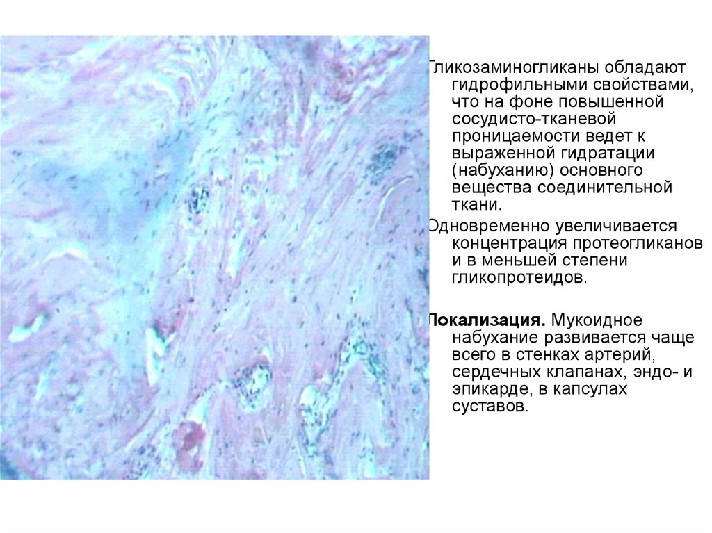 Гиалиноз относится к. Мукоидное набухание патанатомия микропрепарат. Мукоидное набухание соединительной ткани микропрепарат. Фибриноидное набухание микропрепарат. Фибриноидное набухание соединительной ткани.
